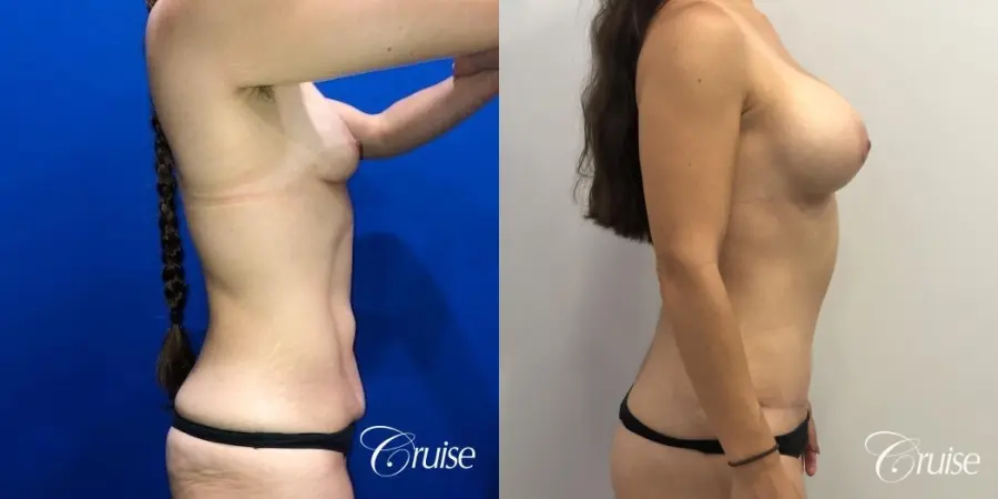 Breast Augmentation, Tummy Tuck - Before and After 4