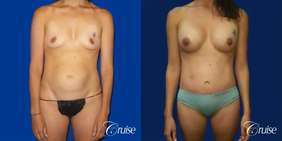 Best Tummy Tuck before and afters Dr. Cruise - Before and After 1