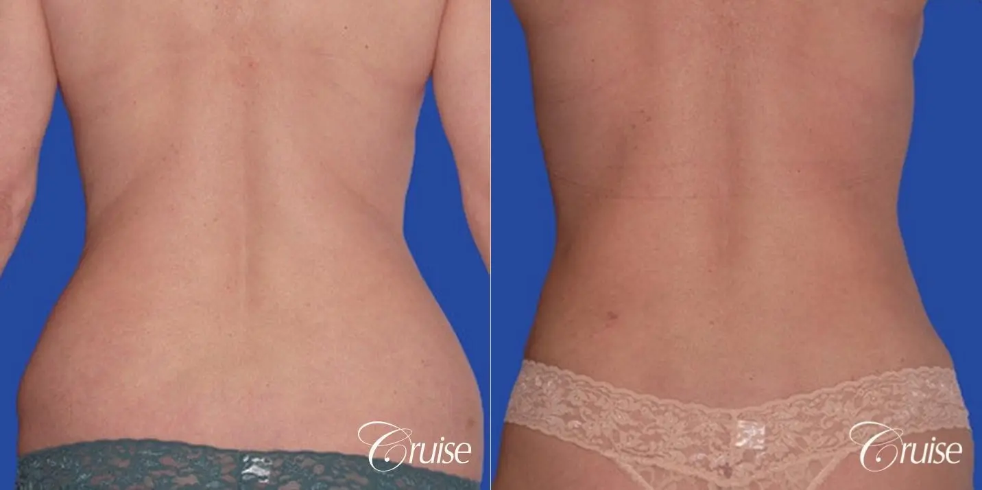 low mini tummy tuck with D cup  breast augmentation - Before and After 3