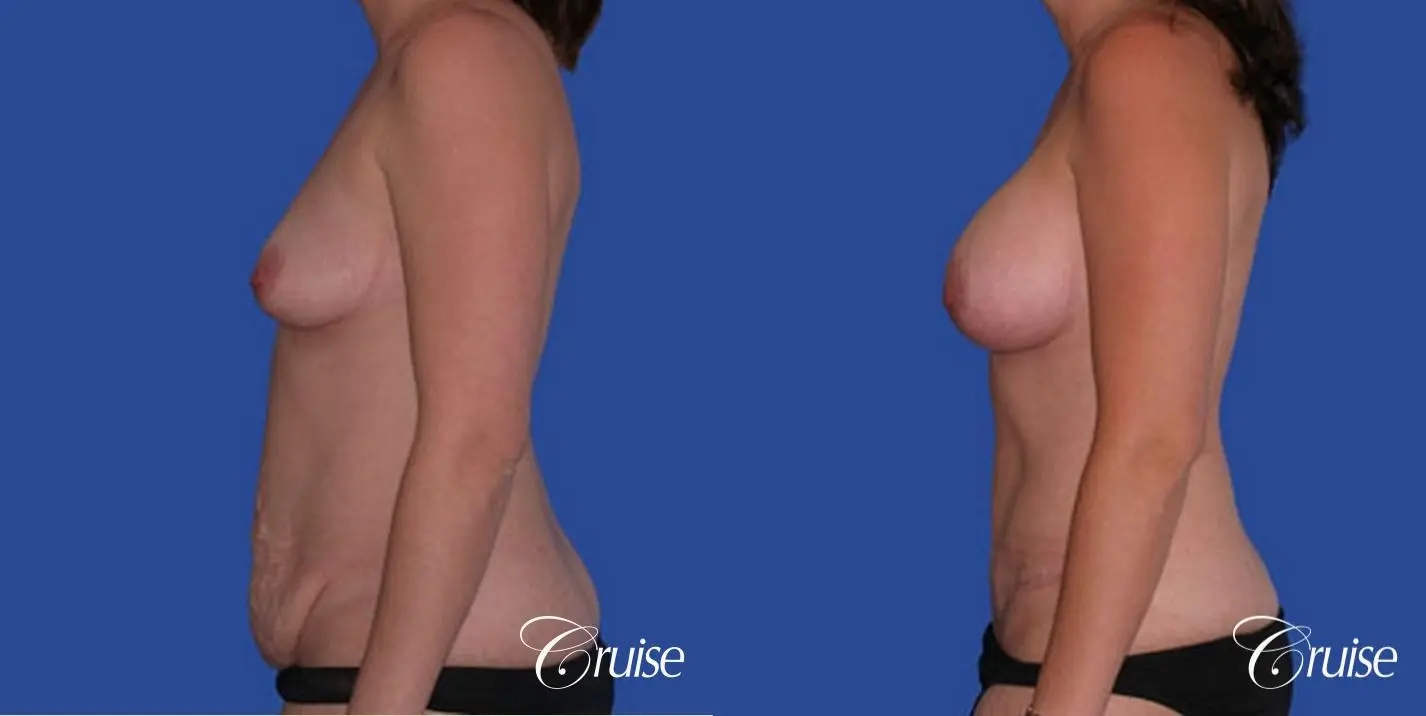 best pictures of tummy tuck with saline breast augmentation - Before and After 2