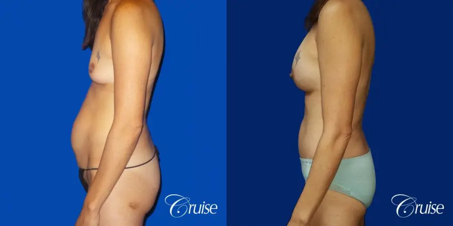 Best Tummy Tuck before and afters Dr. Cruise - Before and After 3