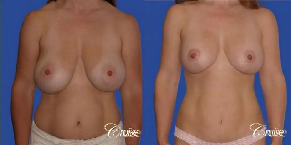 best breast revision tummy tuck mommy make over - Before and After 1