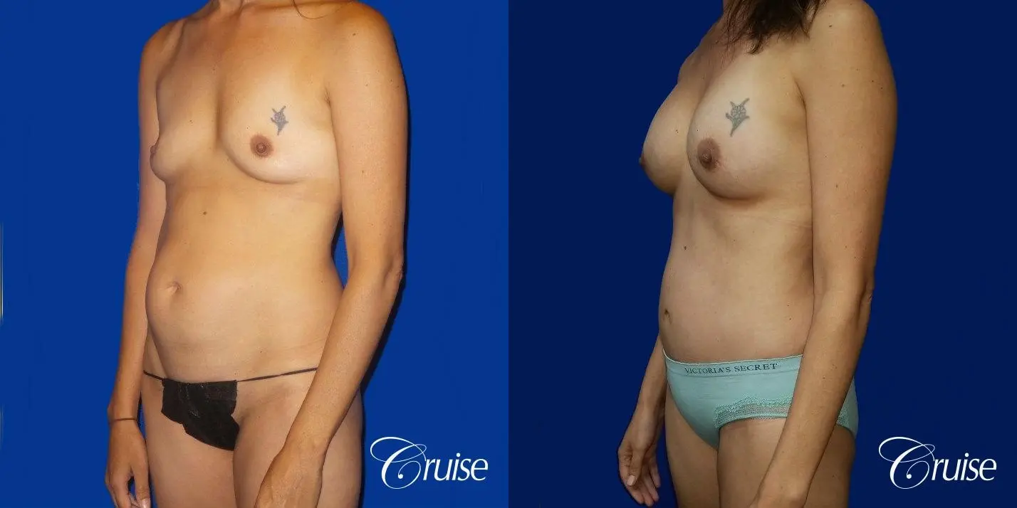 Best Tummy Tuck before and afters Dr. Cruise - Before and After 2