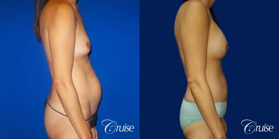 Best Tummy Tuck before and afters Dr. Cruise - Before and After 4