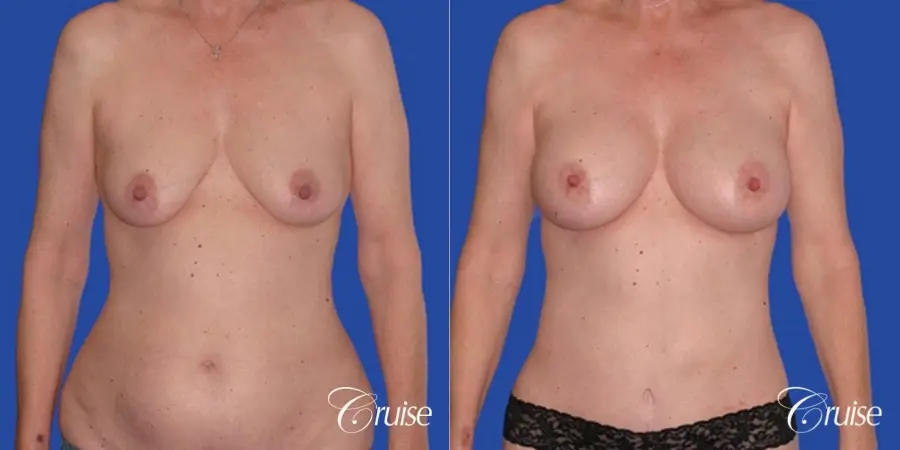 low mini tummy tuck with D cup breast augmentation - Before and After 1