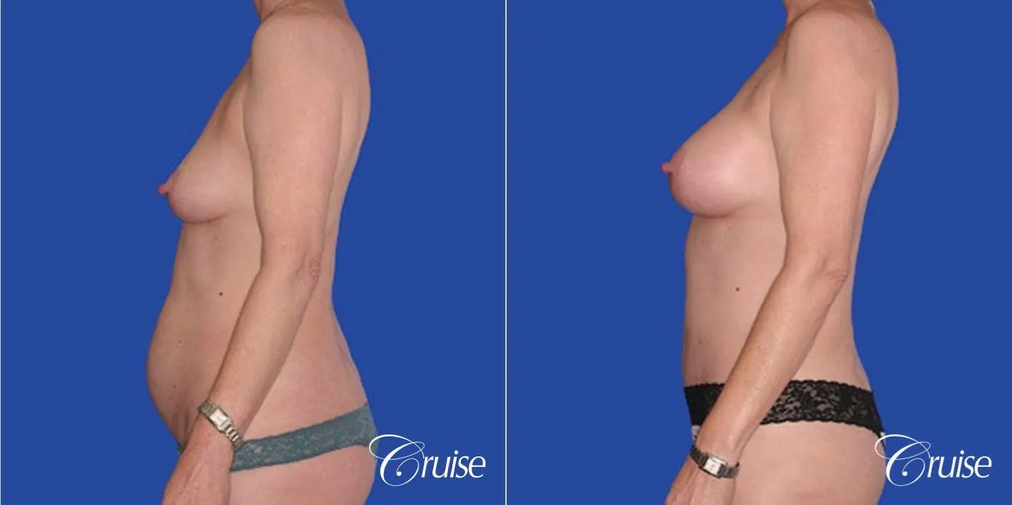 low mini tummy tuck with D cup breast augmentation - Before and After 2