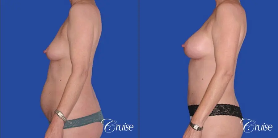 low mini tummy tuck with D cup  breast augmentation - Before and After 2