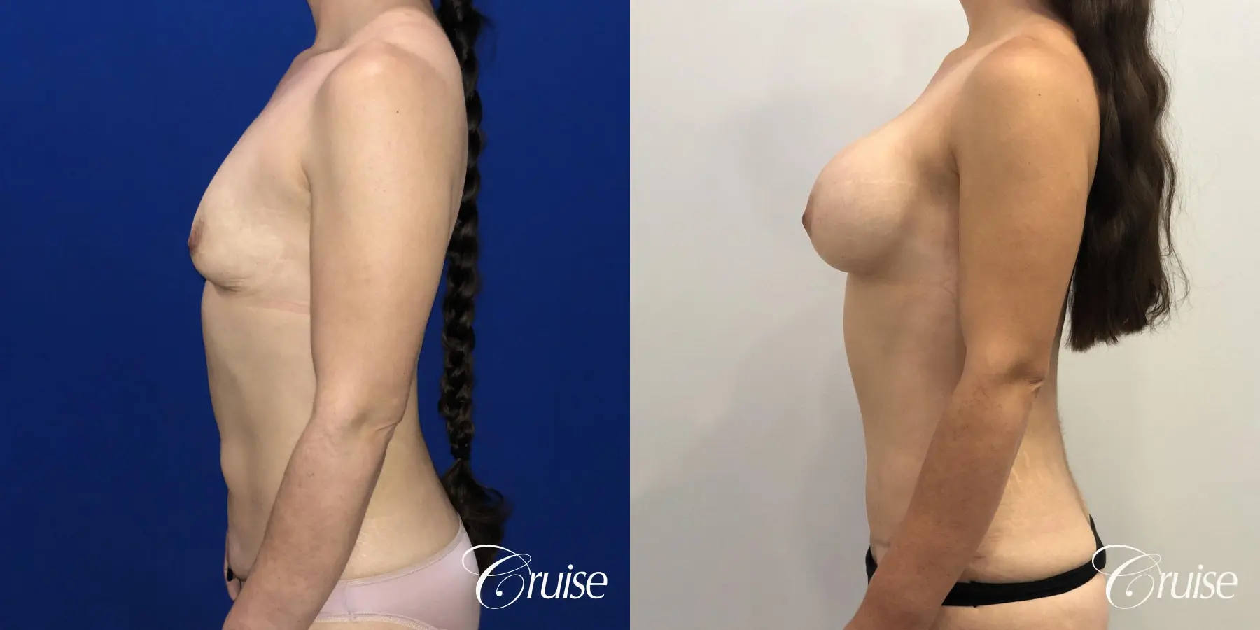 Breast Augmentation, Tummy Tuck - Before and After 2