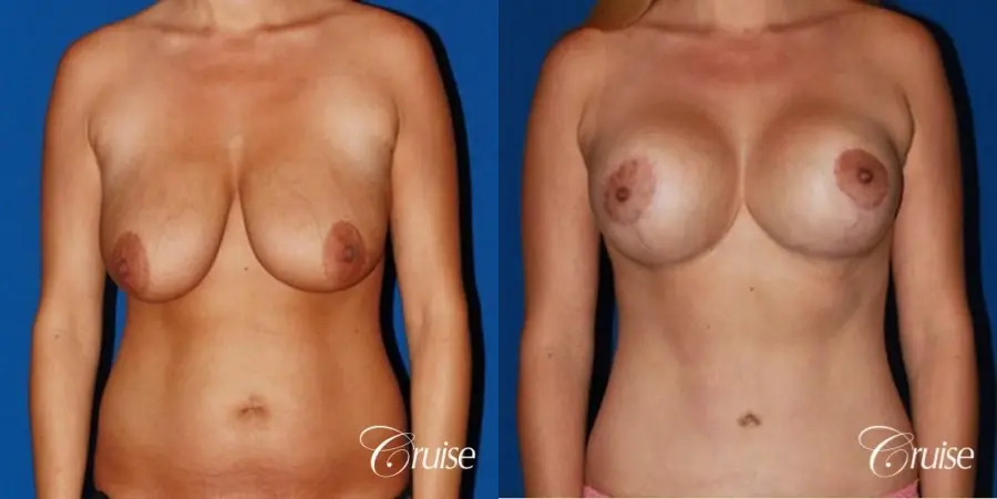 tummy tuck and saline breast lift with large implants on mommy makeover - Before and After 1