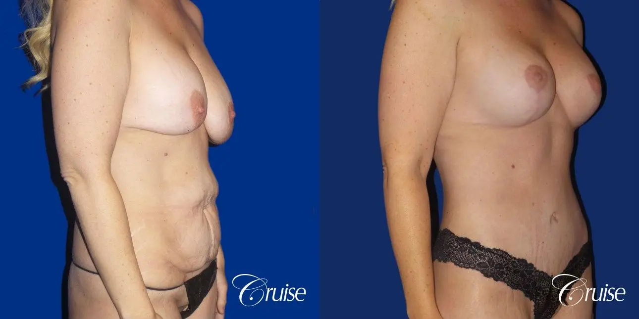 Circumferential Tummy Tuck, Breast Lift Anchor W/ Silicone - Before and After 4