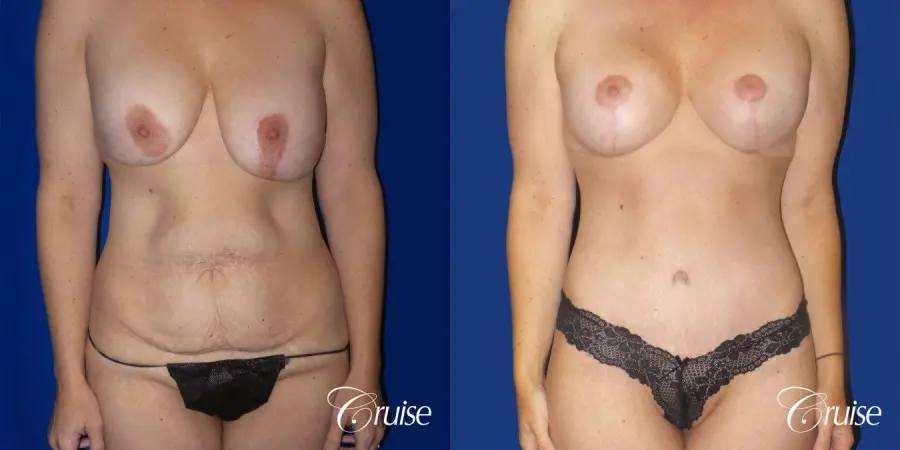Circumferential Tummy Tuck, Breast Lift Anchor W/ Silicone - Before and After  