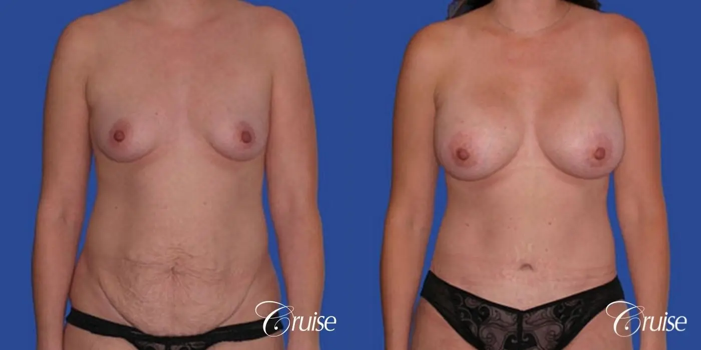 best pictures of tummy tuck with saline breast augmentation - Before and After 1