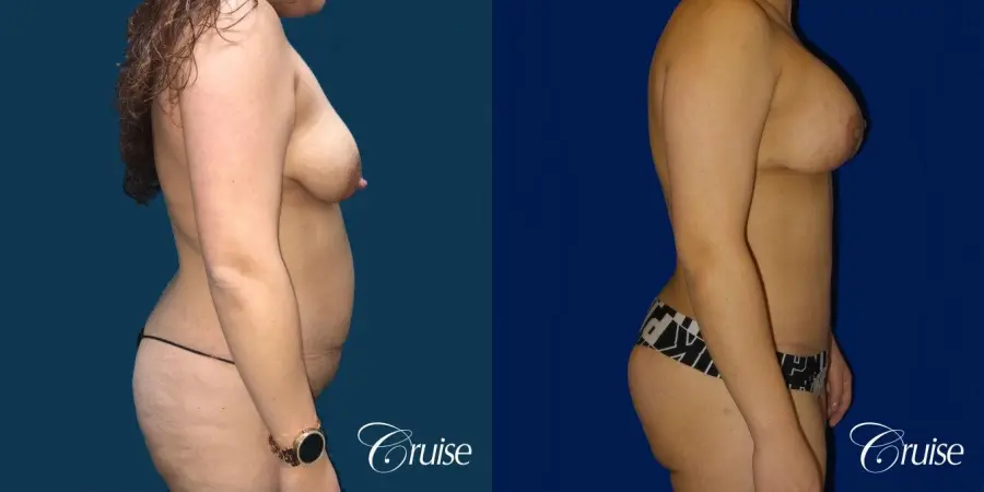 Extended Tummy Tuck, BBL, Breast Lift Anchor With Silicone - Before and After 2