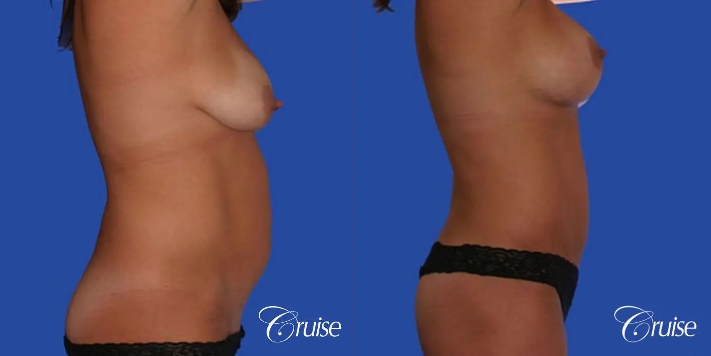mommy makeover with best breast lift anchor with saline implants - Before and After 3