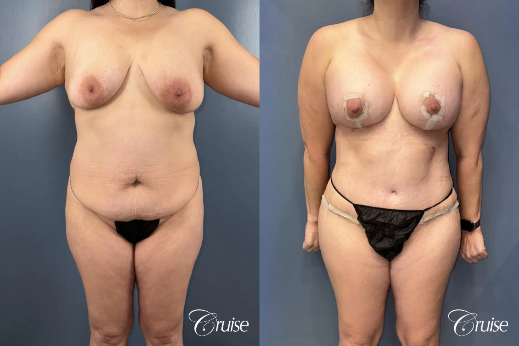 Rediscover Your Confidence with a Mommy Makeover - Before and After 1