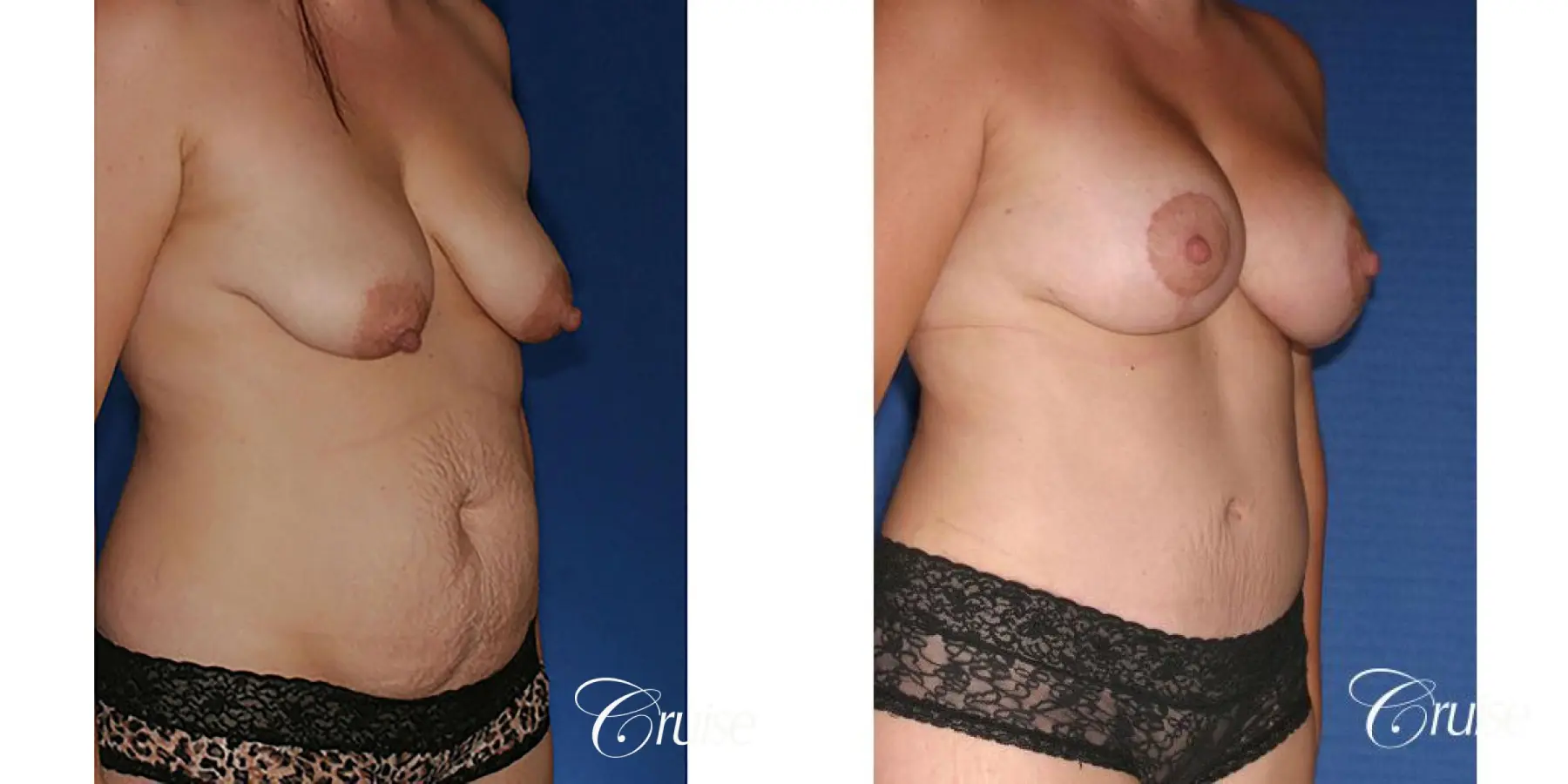 best mommy makeover with saline breast implants - Before and After 4