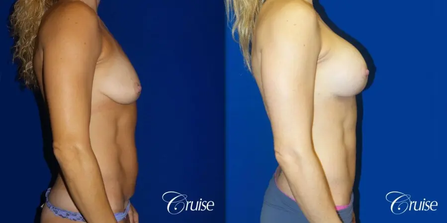 Mommy Makeover Best plastic surgeons - Before and After 2