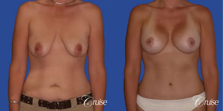 best scar for mommy make over breast lift tummy tuck - Before and After
