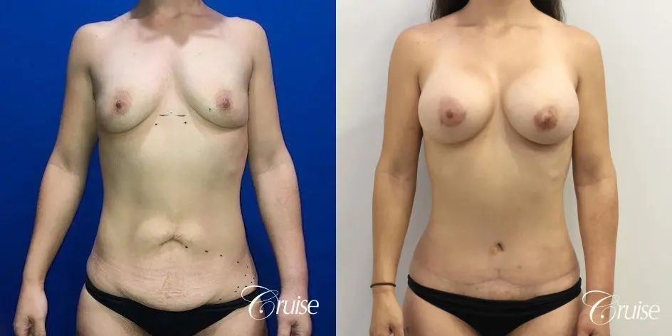 Breast Augmentation, Tummy Tuck - Before and After