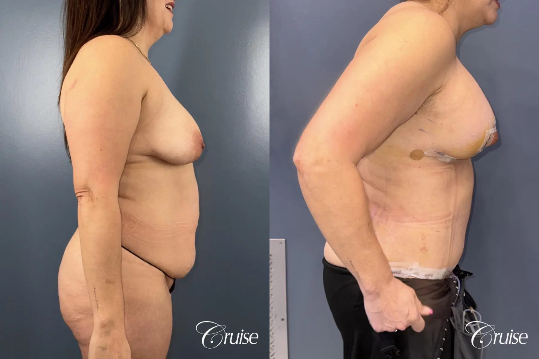Rediscover Your Confidence with a Mommy Makeover - Before and After 2
