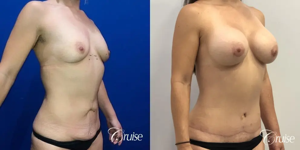 Breast Augmentation, Tummy Tuck - Before and After 3