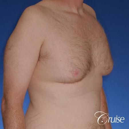 best donut lift with gynecomastia surgery - Before and After Image 4