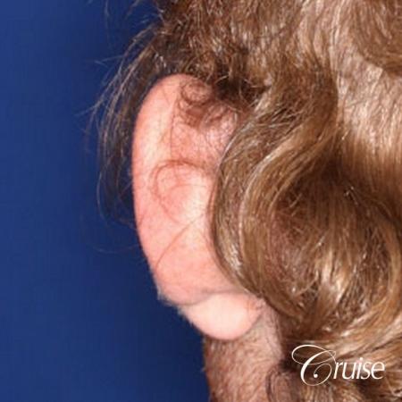 otoplasty before and after pictures newport beach - Before and After Image 3