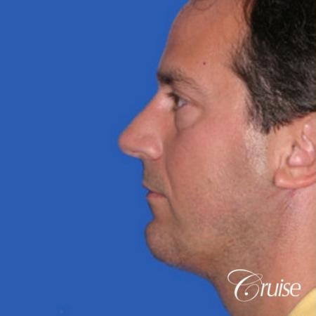 terino square jaw implant after best chin augmentation - After Image 2