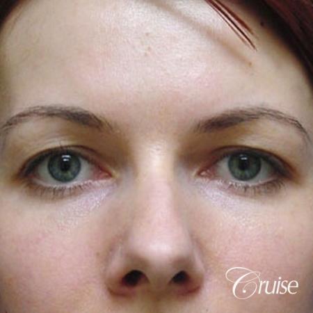best before and after pictures of upper eyelid surgery - Before Image 1