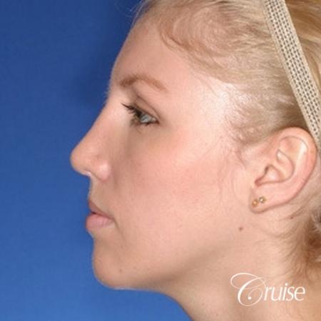 young female with large anatomic chin implant - After Image 2