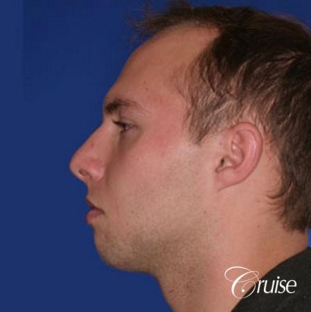 best chin implant on male with medium square jaw - Before Image 2