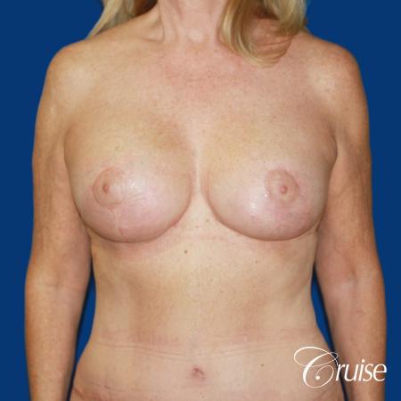 62 yr old woman with breast lift anchor and silicone implants - After Image 1