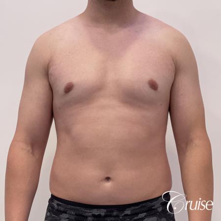 Gynecomastia: Patient 123 - After 1