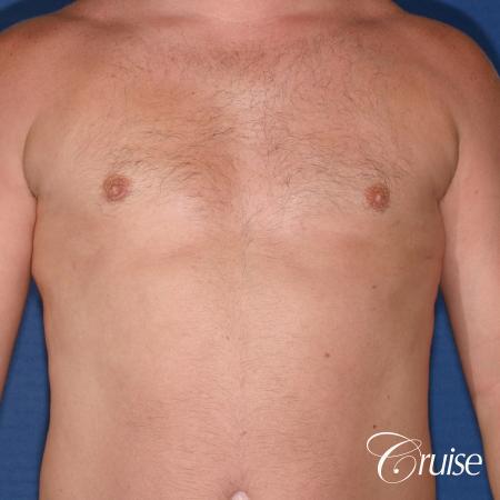 male adult with gynecomastia - After Image 1