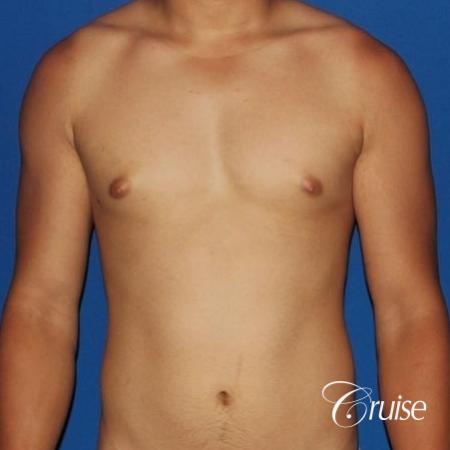 young athletic adult with puffy nipple - Before Image 1
