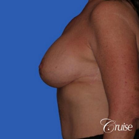 best breast lift anchor with saline augmentation - After Image 2