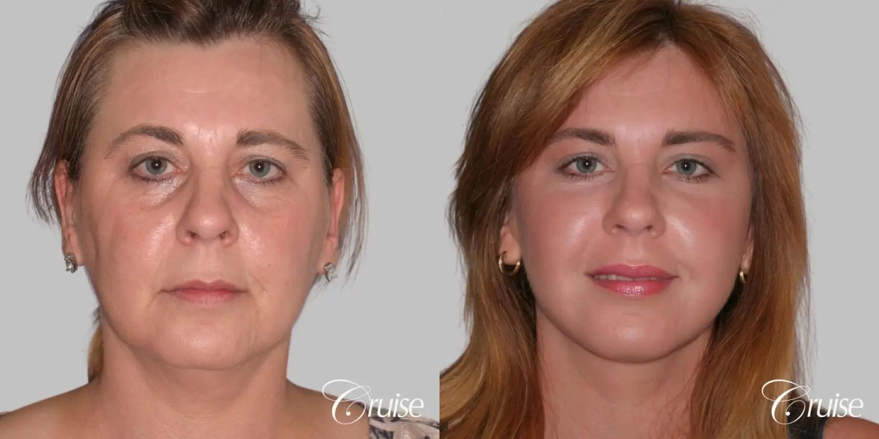 Facelift in Newport Beach, CA - Before and After 1