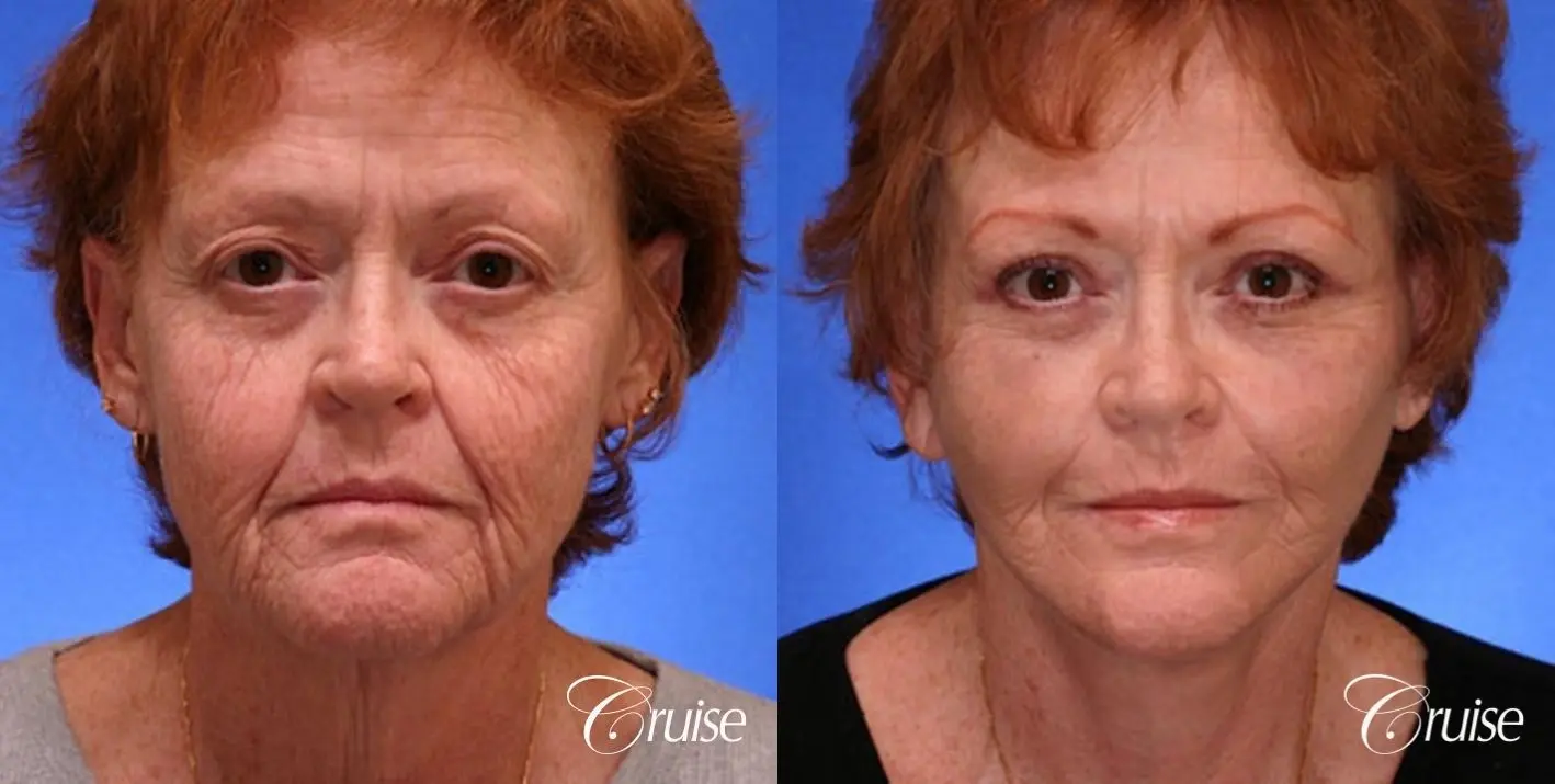 Neck Lift - Before and After 1