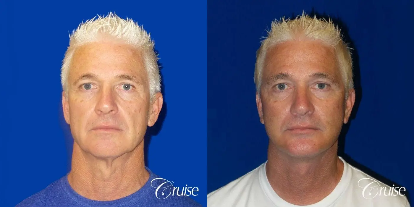 Male neck lift before and after - Before and After 1