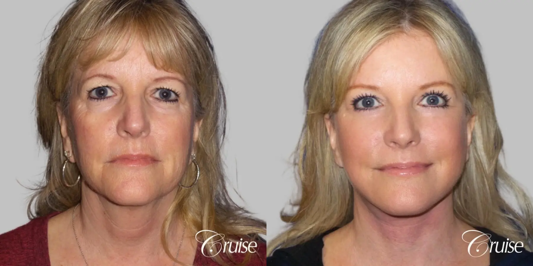 Face Lift surgery Newport Beach Orange County - Before and After 1