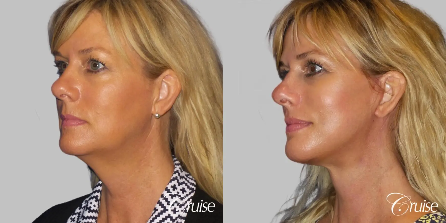 Neck Lift With Lower Face Lift - Before and After 2