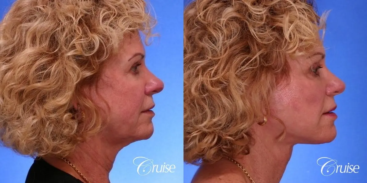 Neck Lift - Before and After 4