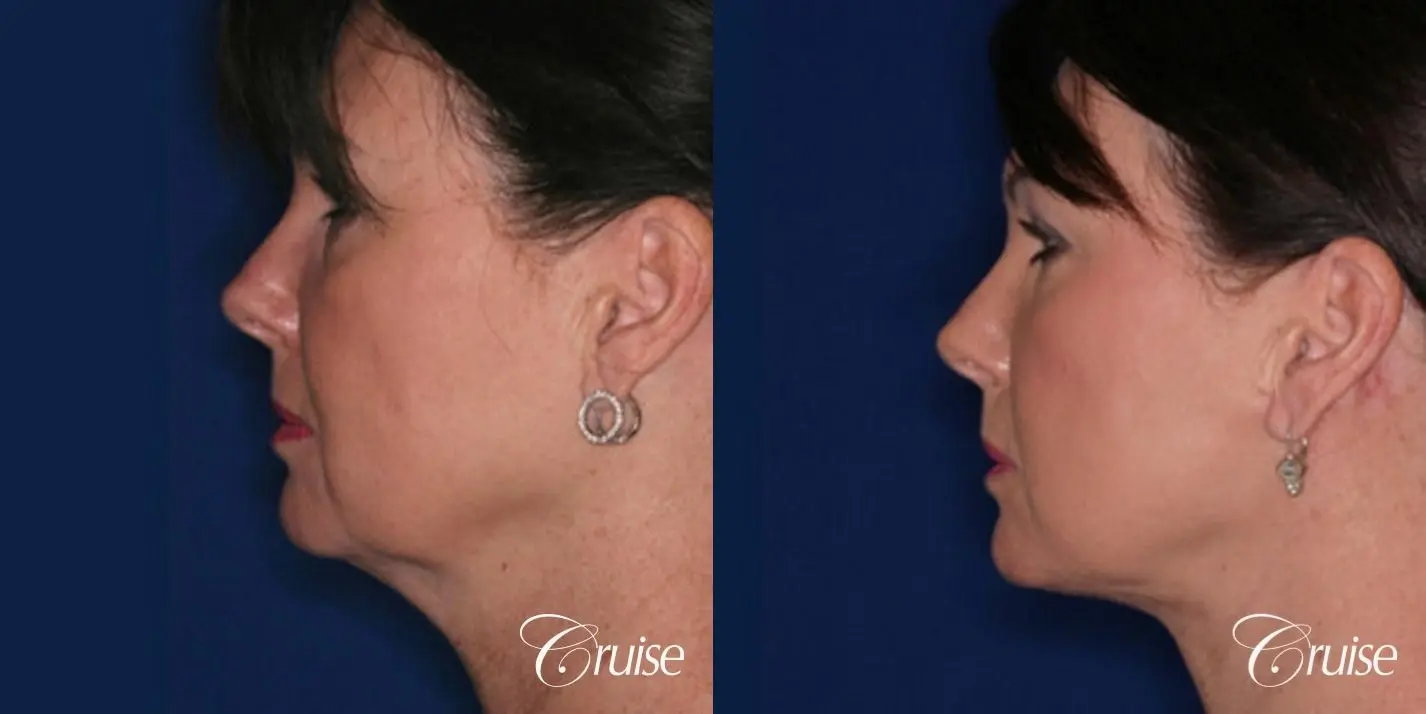 Neck Lift - Before and After 2