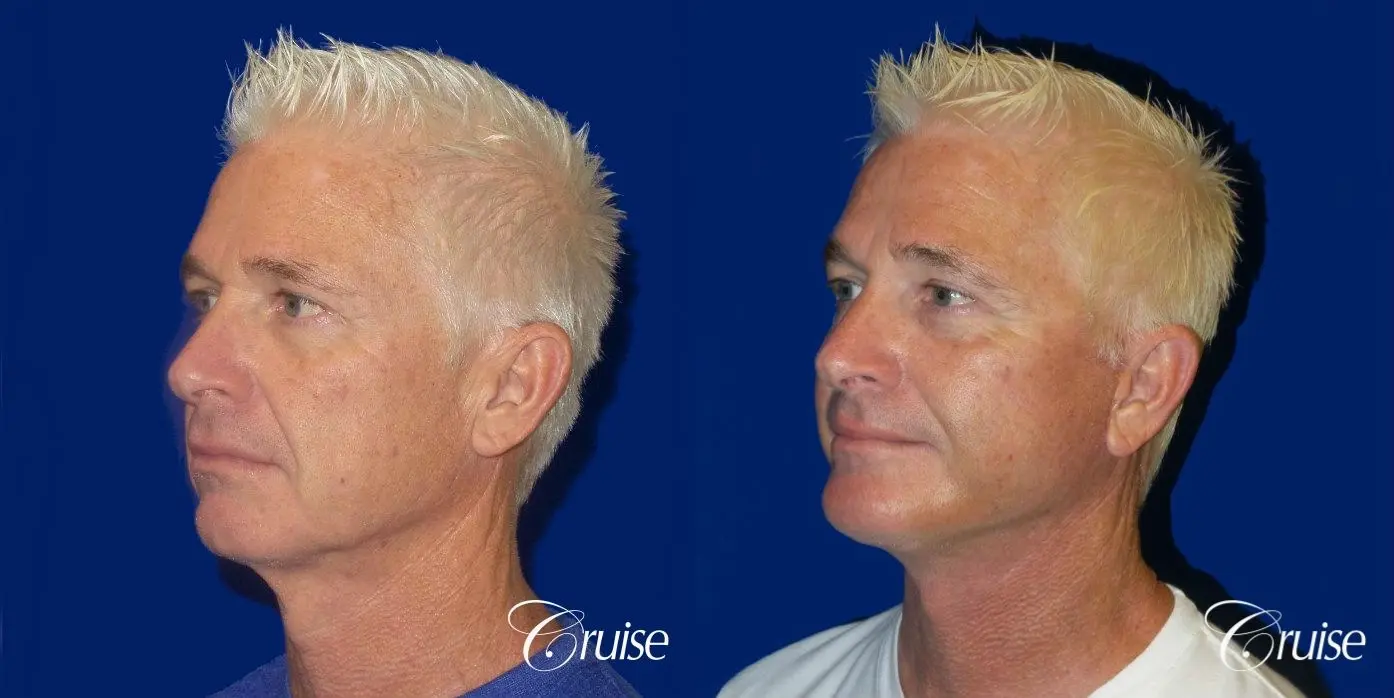 Male neck lift before and after - Before and After 2