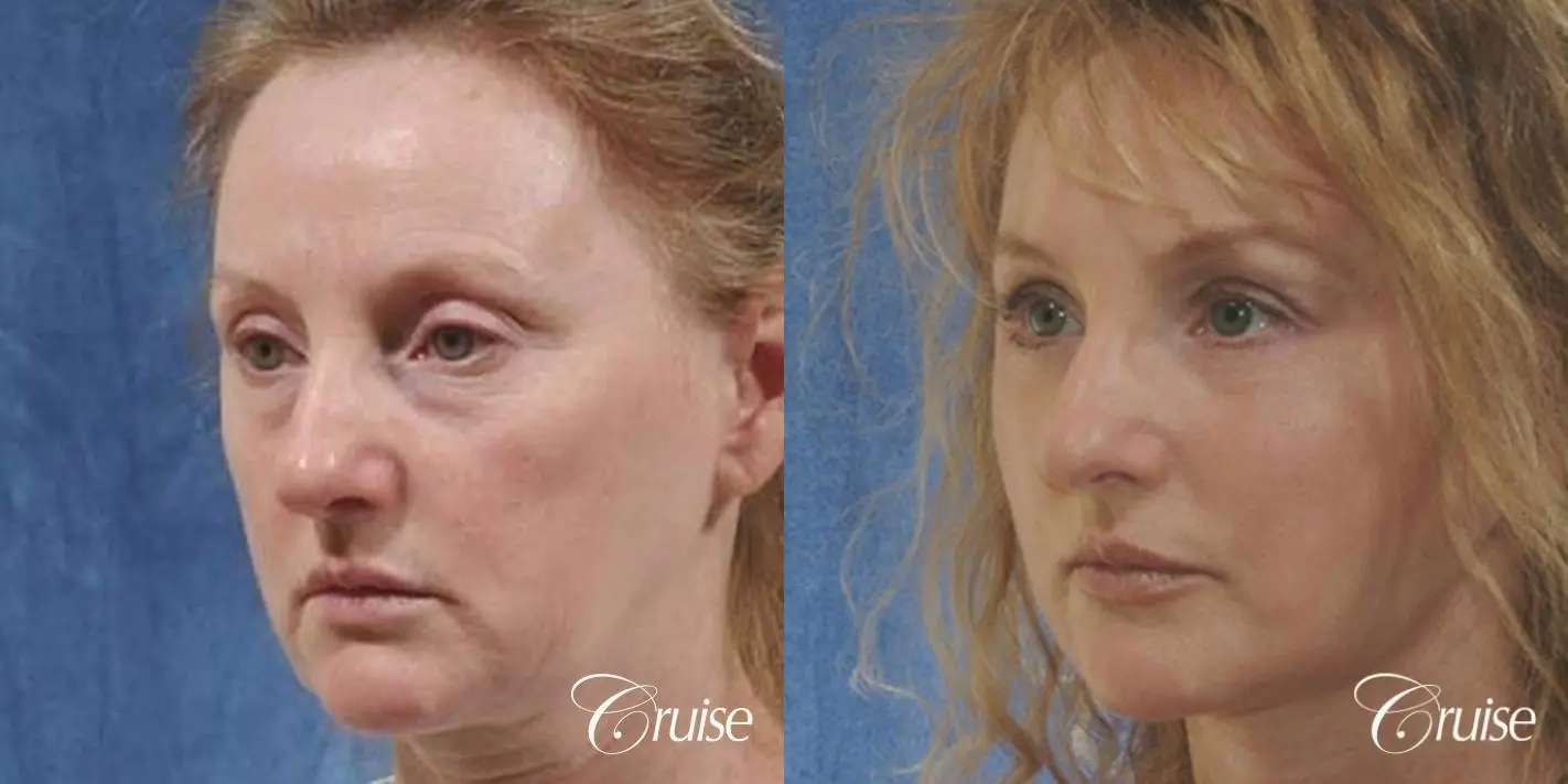 Face Lift - Before and After 2