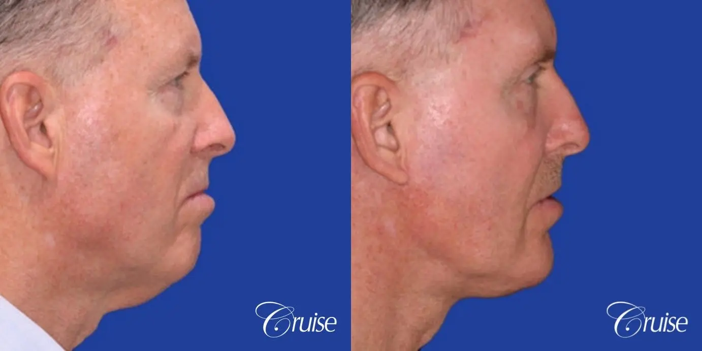 Neck Lift - Before and After 3