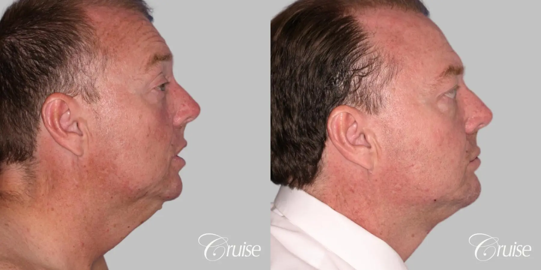 Lower Facelift, Necklift - Male Patient - Before and After 2