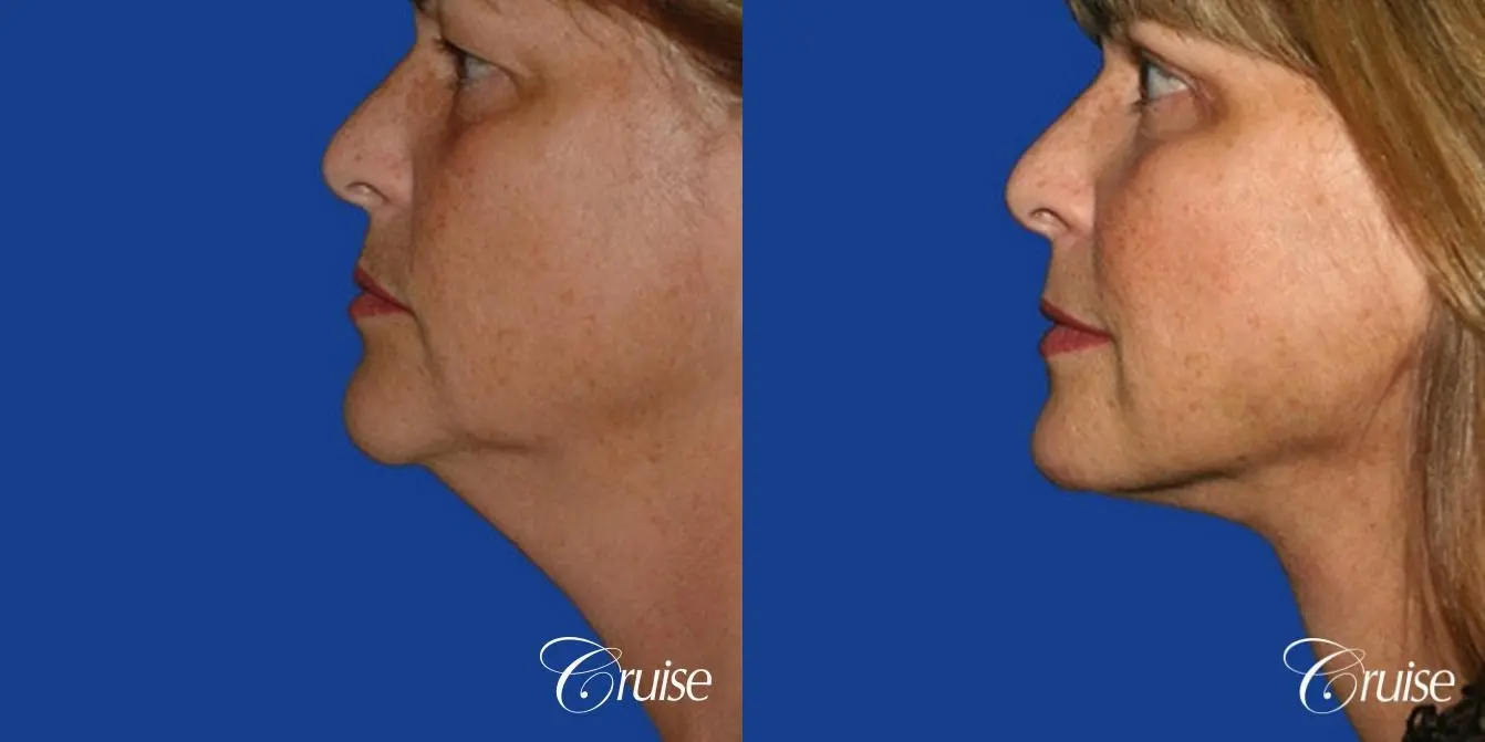 Neck Lift - Before and After 2