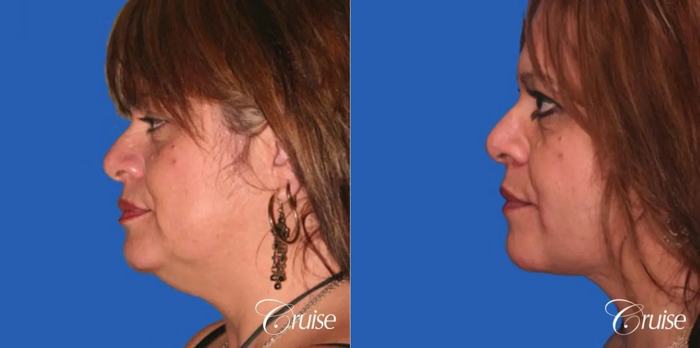 Neck Lift - Before and After 2