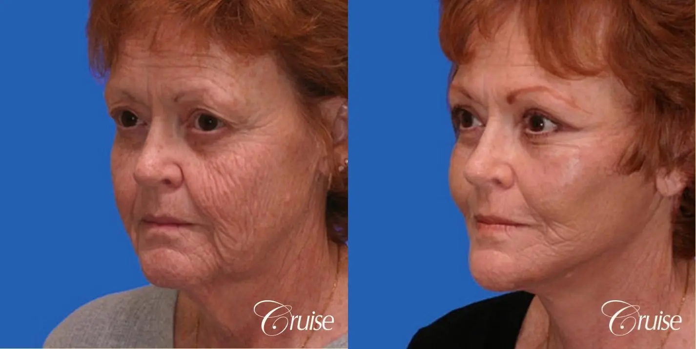 Neck Lift - Before and After 2